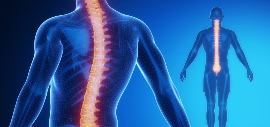 SCOLIOSIS – WHEN DO YOU CONTACT A SPINE SPECIALIST?