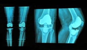 knee replacement xray